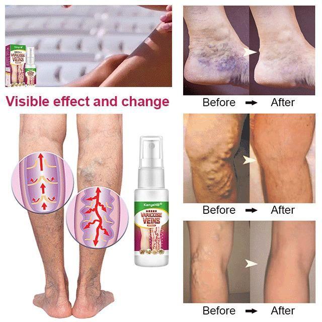 Vein Healing Varicose Veins Treatment Spray